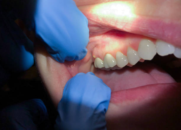 Best Emergency Denture Repair in Newtown, PA